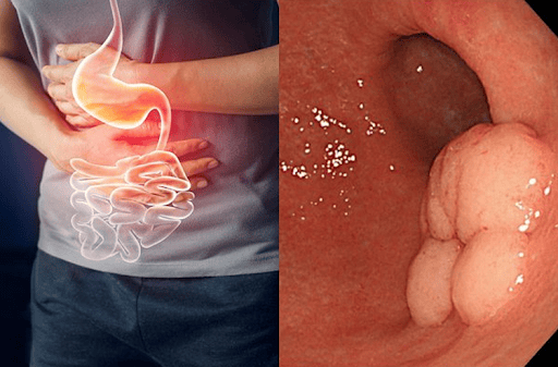 Chỉ nghĩ bị viêm đường tiêu hóa, nam sinh 17 tuổi đi khám phát hiện ung thư dạ dày: Có dấu hiệu này không nên chủ quan - Ảnh 1.