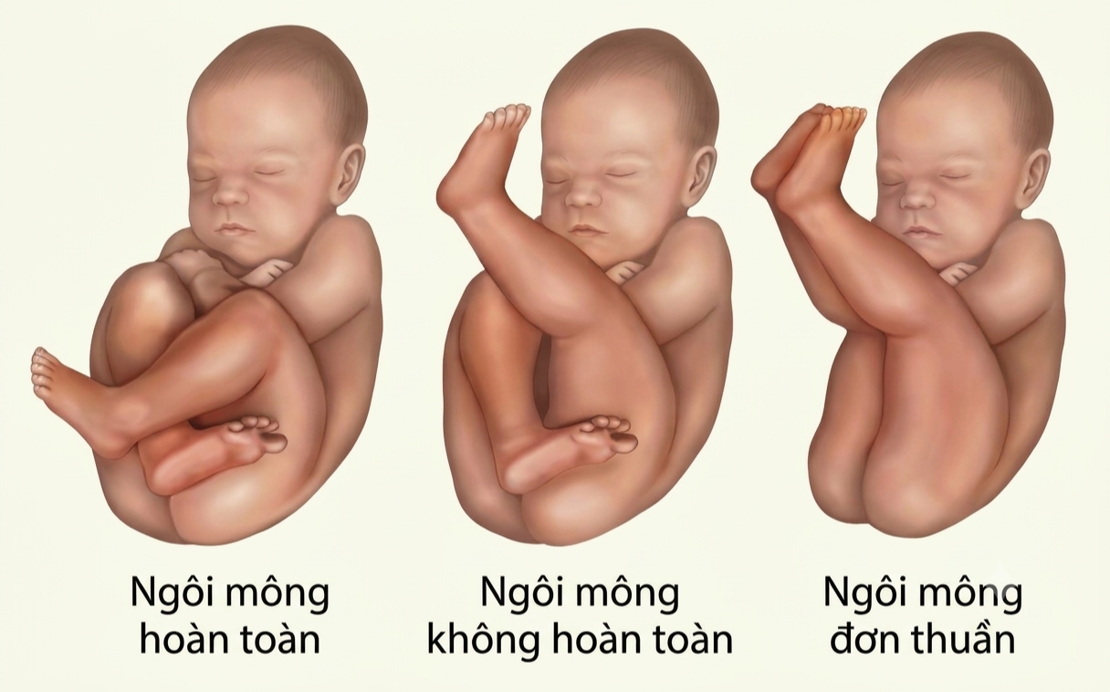 Thai nhi ng&ocirc;i ngược: Nguy&ecirc;n nh&acirc;n, xử tr&iacute; v&agrave; lựa chọn sinh nở an to&agrave;n - Ảnh 1.