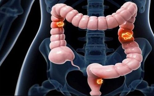 Nam sinh viên 22 tuổi mắc ung thư đại tràng giai đoạn 4 thừa nhận bỏ qua 3 dấu hiệu báo bệnh này - Ảnh 1.