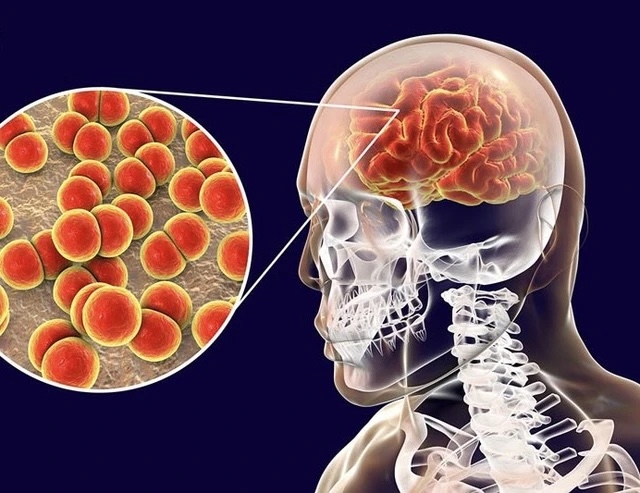 Bệnh do não mô cầu có thể diễn tiến tối cấp: 5 dấu hiệu cha mẹ không nên bỏ qua 1 Bệnh do não mô cầu có thể diễn tiến tối cấp: 5 dấu hiệu cha mẹ không nên bỏ qua - Ảnh 1.