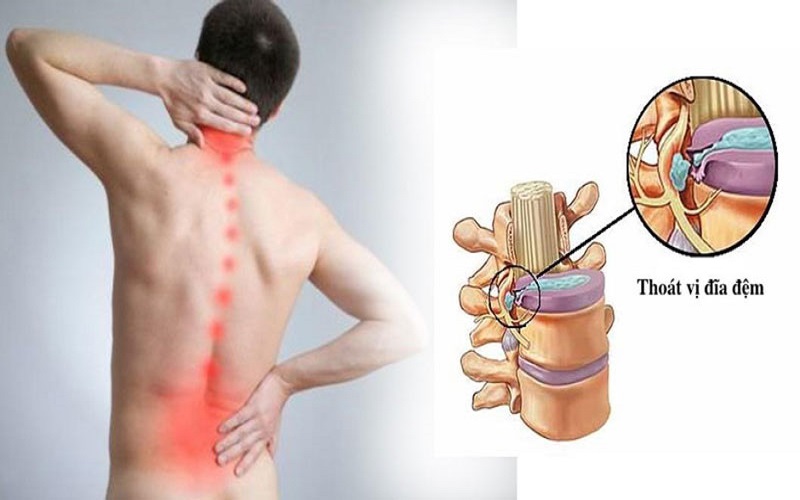 Đau lưng dữ dội sau một lần vận động sai tư thế, người đ&agrave;n &ocirc;ng 37 tuổi ph&aacute;t hiện tho&aacute;t vị đĩa đệm - Ảnh 2.