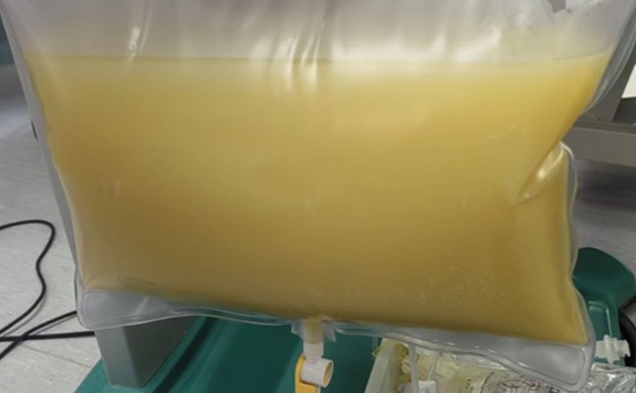 Nam sinh vi&ecirc;m tụy cấp, mỡ m&aacute;u cao gấp 47 lần thừa nhận một sai lầm nhiều bạn trẻ Việt mắc phải - Ảnh 1.