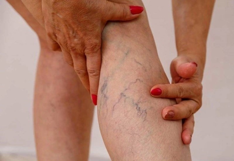 Người đ&agrave;n &ocirc;ng 63 tuổi bị suy gi&atilde;n tĩnh mạch nghi&ecirc;m trọng v&igrave; l&agrave;m việc n&agrave;y trong suốt 30 năm - Ảnh 2.