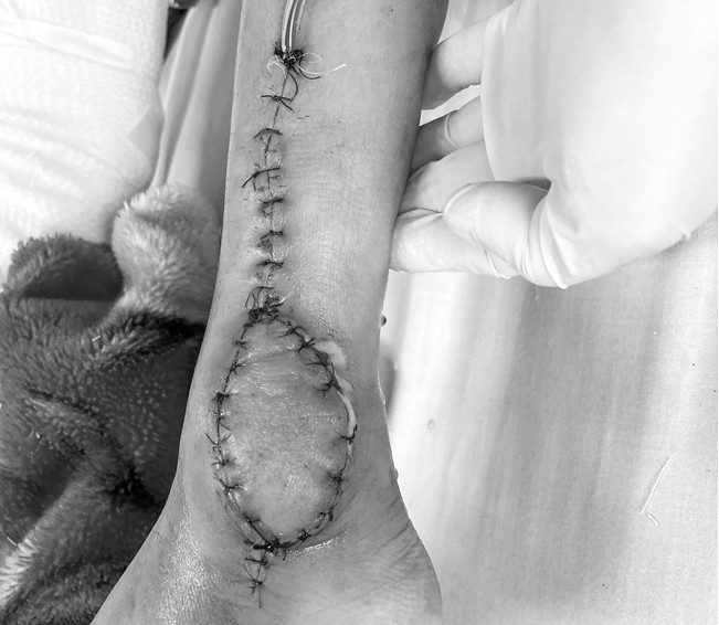 Bé 8 tuổi ở Hà Nội phát hiện mắc ung thư sụn từ dấu hiệu đau chân bất thường - Ảnh 1.