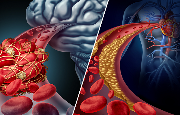 Người phụ nữ 70 tuổi nhồi m&aacute;u cơ tim l&uacute;c nửa đ&ecirc;m từ dấu hiệu nhiều người bỏ qua - Ảnh 2.