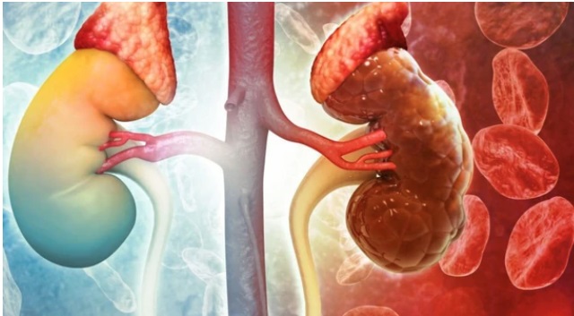 C&ocirc; g&aacute;i 28 tuổi đối diện nguy cơ suy thận sai lầm trong l&uacute;c giảm c&acirc;n nhiều người Việt mắc phải - Ảnh 2.