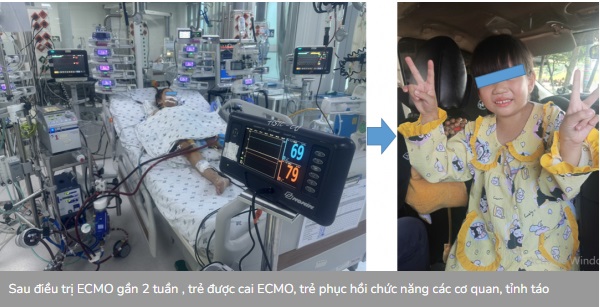 B&eacute; g&aacute;i 7 tuổi đột ngột ngất ở trường do vi&ecirc;m cơ tim tối cấp  - Ảnh 1.