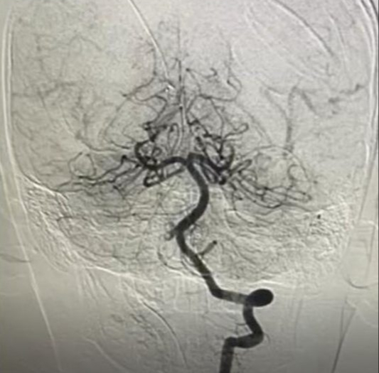 Bé trai 10 tuổi đột quỵ sau khi chơi cầu lông, bác sĩ cảnh báo dấu hiệu dễ bị bỏ qua ở trẻ - Ảnh 1. Bé trai 10 tuổi đột quỵ sau khi chơi cầu lông, bác sĩ cảnh báo dấu hiệu dễ bị bỏ qua ở trẻ - Ảnh 1.