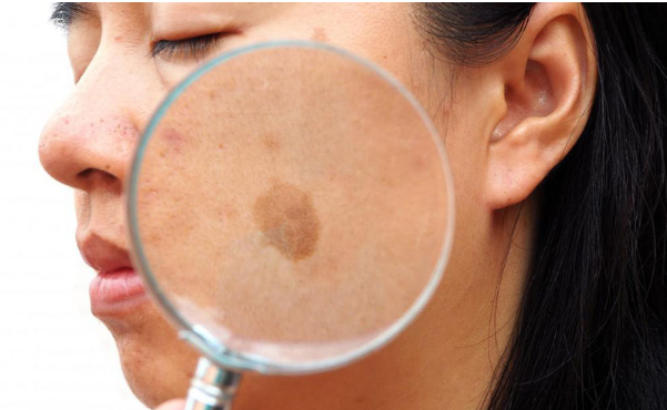 Nhận diện thủ phạm g&acirc;y đốm đồi mồi tr&ecirc;n da- Ảnh 1.