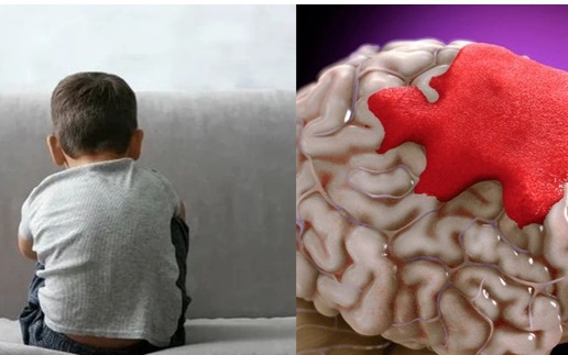 B&eacute; trai 10 tuổi đột quỵ sau khi chơi cầu l&ocirc;ng, b&aacute;c sĩ cảnh b&aacute;o dấu hiệu dễ bị bỏ qua ở trẻ