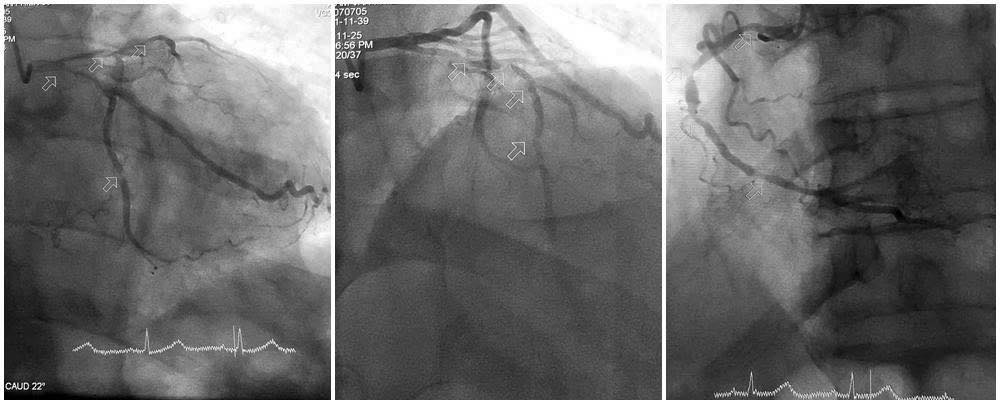 Người đàn ông ở Quảng Ninh bị nhồi máu cơ tim cấp nguy hiểm từ dấu hiệu nhiều người Việt mác phải - Ảnh 1.