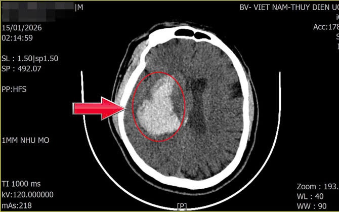 Người đàn ông 44 tuổi khỏe mạnh đột quỵ: Dấu hiệu nhiều người Việt mắc phải