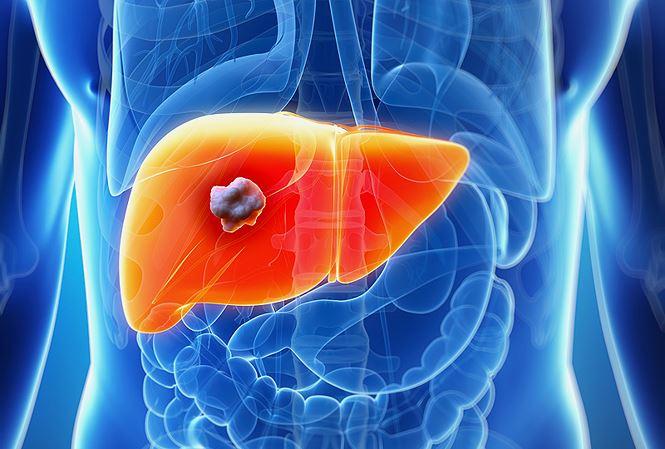 Một người đàn ông 44 tuổi phát hiện ung thư gan sau khi xét nghiệm men gan tăng cao: Có 1 thói quen nhiều người Việt mắc phải - Ảnh 2.