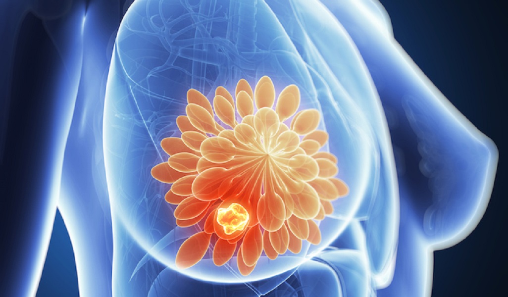 Người phụ nữ 42 tuổi phát hiện ung thư vú từ 1 việc nhiều chị em Việt bỏ qua - Ảnh 1.