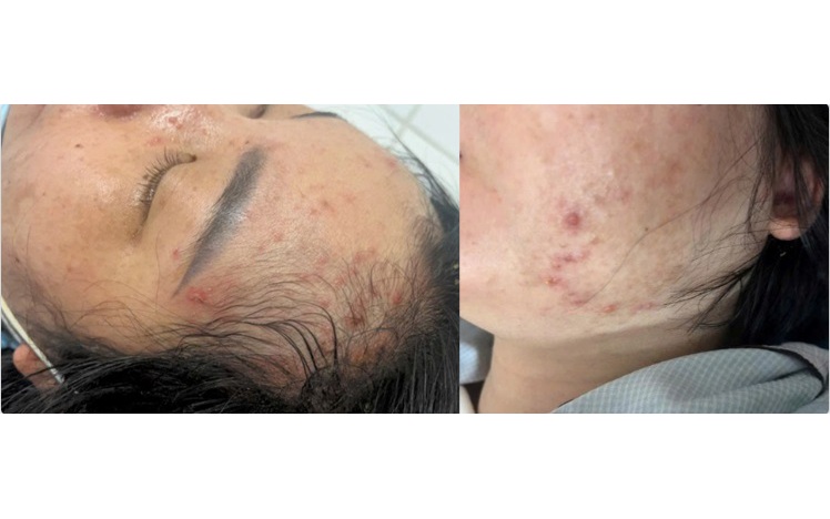 Thai ngo&agrave;i tử cung: Người phụ nữ 23 tuổi ph&aacute;t hiện muộn, su&yacute;t gặp biến chứng nguy hiểm - Ảnh 3.