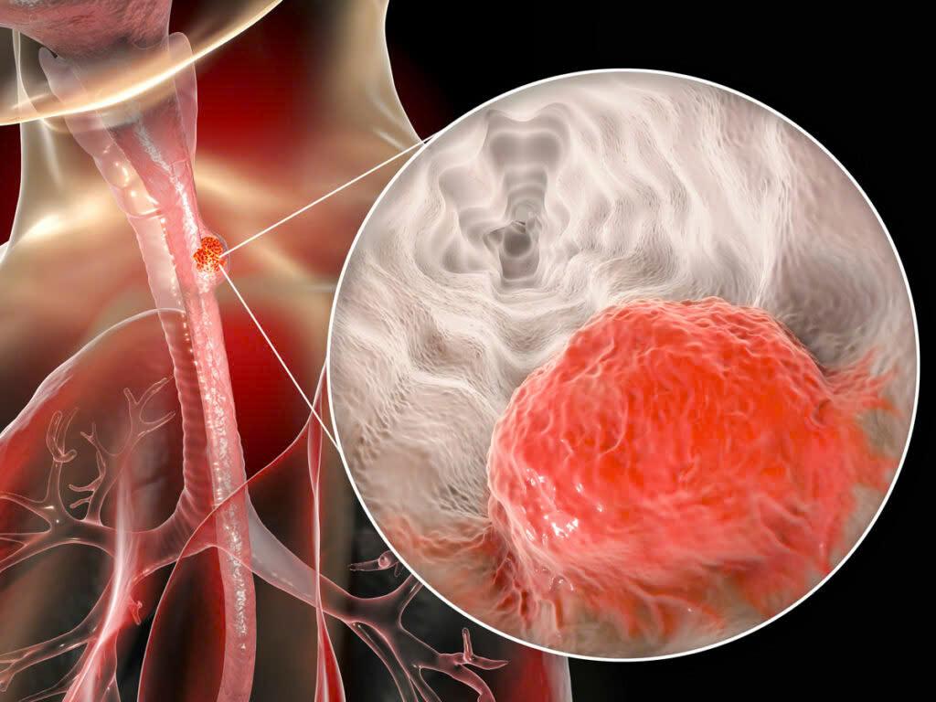 Người đàn ông mắc ung thư thực quản thừa nhận 2 sai lầm nhiều người Việt mắc phải - Ảnh 2.