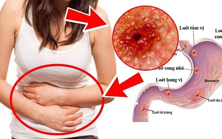 Cô gái 23 tuổi phát hiện ung thư dạ dày từ dấu hiệu nhiều người Việt bỏ qua