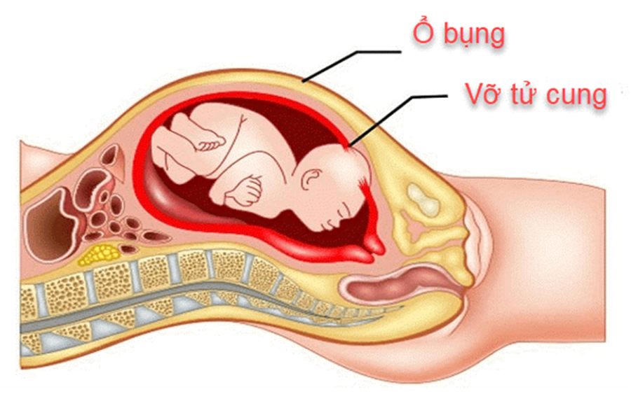 Sản phụ 29 tuổi tử vong trong đêm, thừa nhận sai lầm nhiều phụ nữ Việt mắc phải