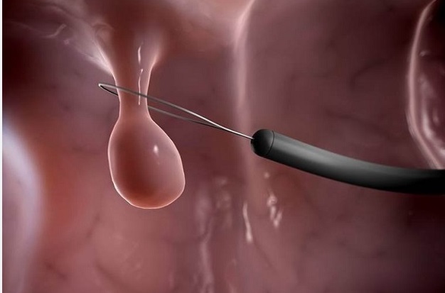 Người phụ nữ 36 tuổi ở H&agrave; Nội kh&aacute;m v&ocirc; sinh: Ph&aacute;t hiện polyp mọc chi ch&iacute;t trong buồng tử cung - Ảnh 2.