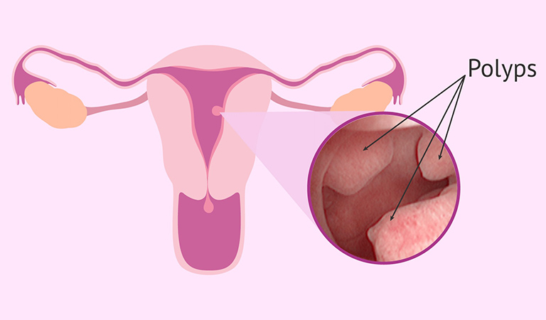 Dấu hiệu cảnh b&aacute;o polyp nội mạc tử cung cần đi kh&aacute;m- Ảnh 1.