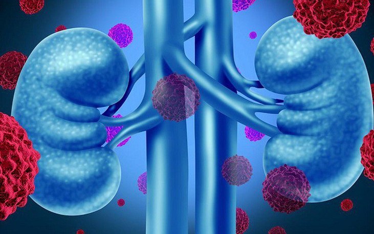 Người phụ nữ 67 tuổi bất ngờ ph&aacute;t hiện ung thư thận giai đoạn sớm từ 1 việc nhiều người Việt bỏ qua