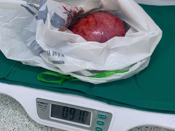 Phẫu thuật th&agrave;nh c&ocirc;ng khối u sau ph&uacute;c mạc khổng lồ nằm ở vị tr&iacute; phức tạp- Ảnh 2.