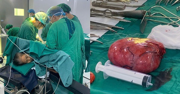 Phẫu thuật thành công khối u sau phúc mạc khổng lồ tại vị trí phức tạp
