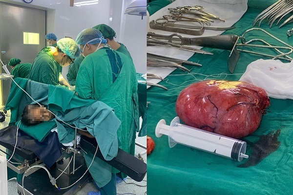 Phẫu thuật th&agrave;nh c&ocirc;ng khối u sau ph&uacute;c mạc khổng lồ nằm ở vị tr&iacute; phức tạp- Ảnh 1.