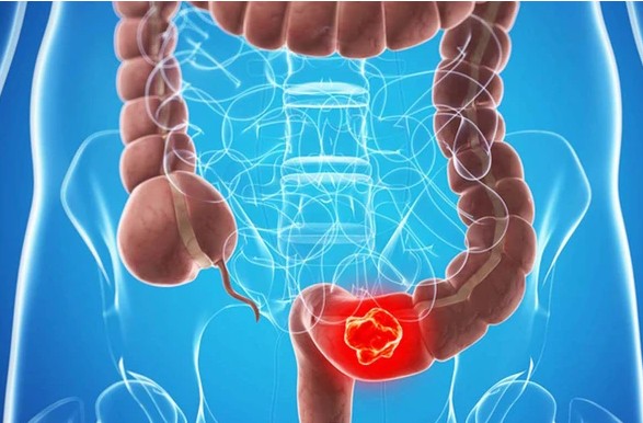 Người đ&agrave;n &ocirc;ng ph&aacute;t hiện ung thư trực tr&agrave;ng từ dấu hiệu mơ hồ, nhiều người Việt mắc phải - Ảnh 1.