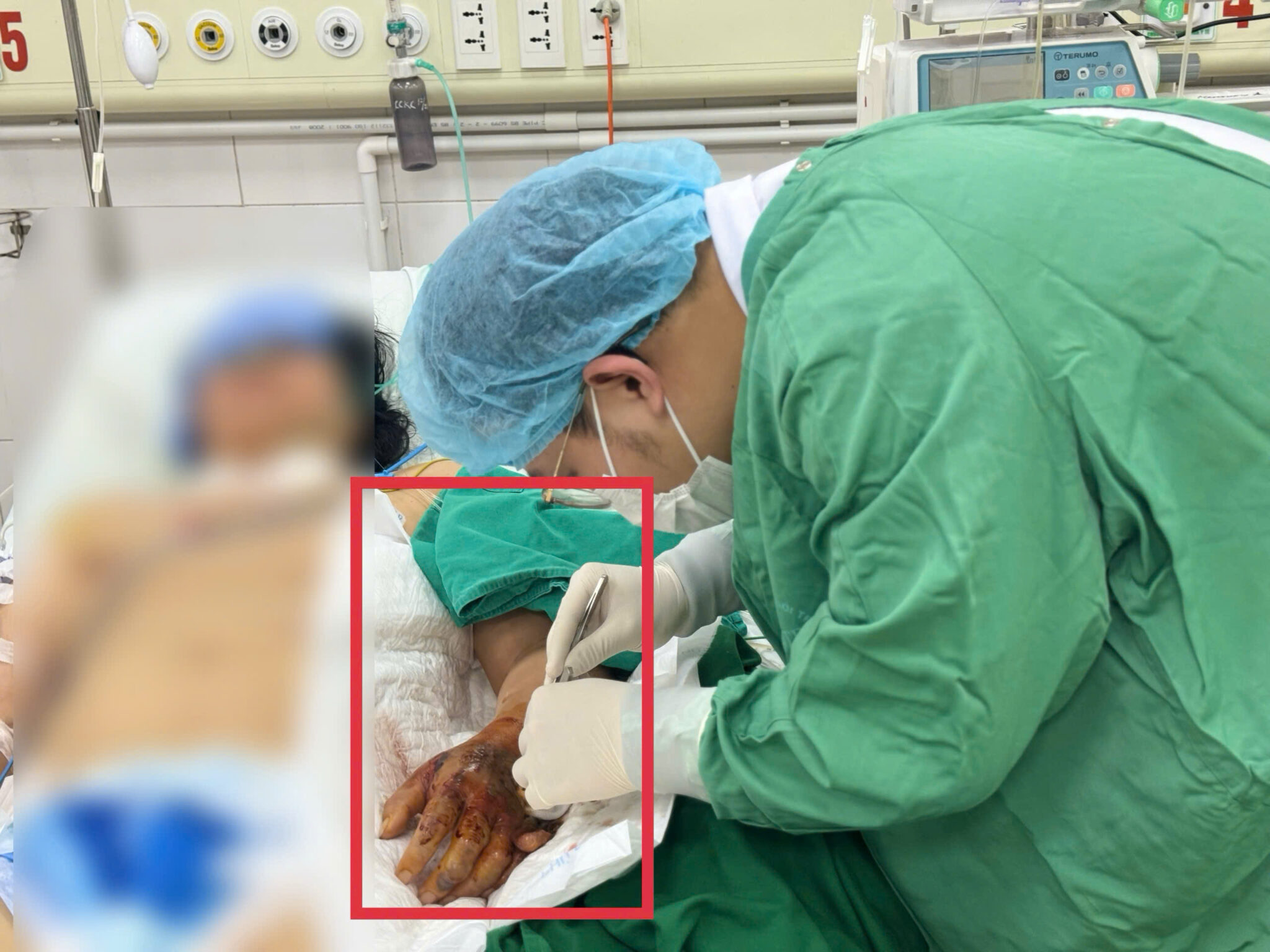 Người phụ nữ 52 tuổi ở Bắc Ninh sốc nhiễm khuẩn, suy đa tạng chỉ từ một tổn thương nhỏ nhiều người Việt rất hay bỏ qua - Ảnh 1.