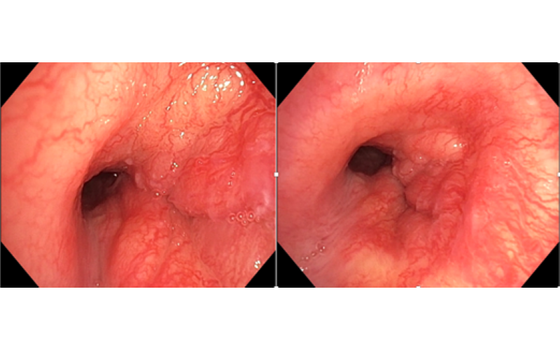 Người đ&agrave;n &ocirc;ng 32 tuổi ph&aacute;t hiện ung thư phổi hiếm gặp từ dấu hiệu nhiều người Việt mắc phải