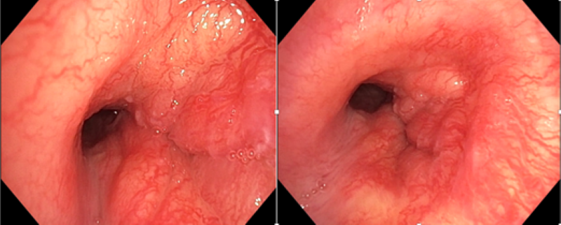 Người đàn ông 32 tuổi phát hiệu ung thư đường thở hiếm gặp từ dấu hiệu nhiều người Việt mắc phải - Ảnh 1.