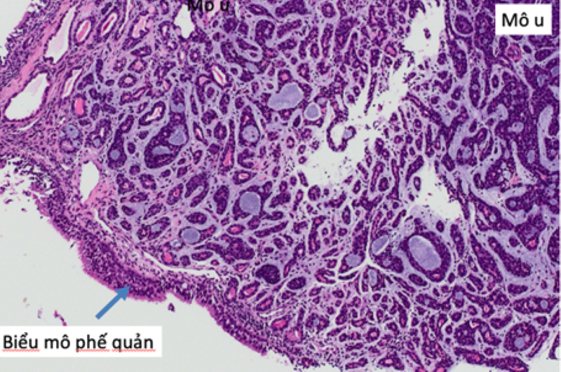 Người đàn ông 32 tuổi phát hiệu ung thư đường thở hiếm gặp từ dấu hiệu nhiều người Việt mắc phải - Ảnh 2.