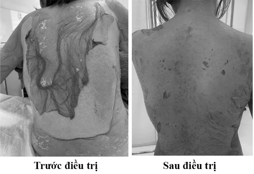 Người phụ nữ 35 tuổi bị tróc da toàn thân thừa nhận 1 sai lầm nhiều người Việt mắc phải - Ảnh 1.