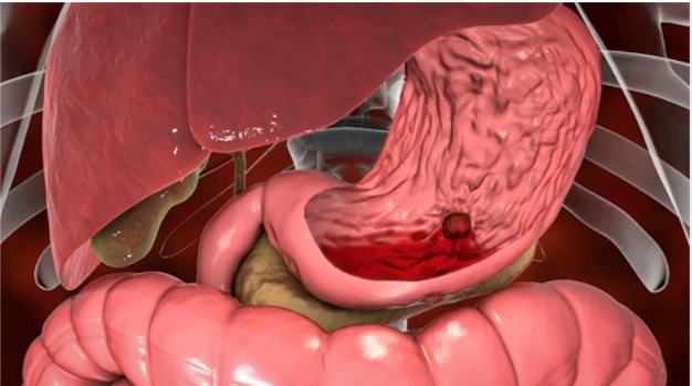 Người đ&agrave;n &ocirc;ng 65 tuổi thiếu m&aacute;u nặng do xuất huyết dạ d&agrave;y v&igrave; 1 sai lầm nhiều người Việt mắc phải - Ảnh 2.