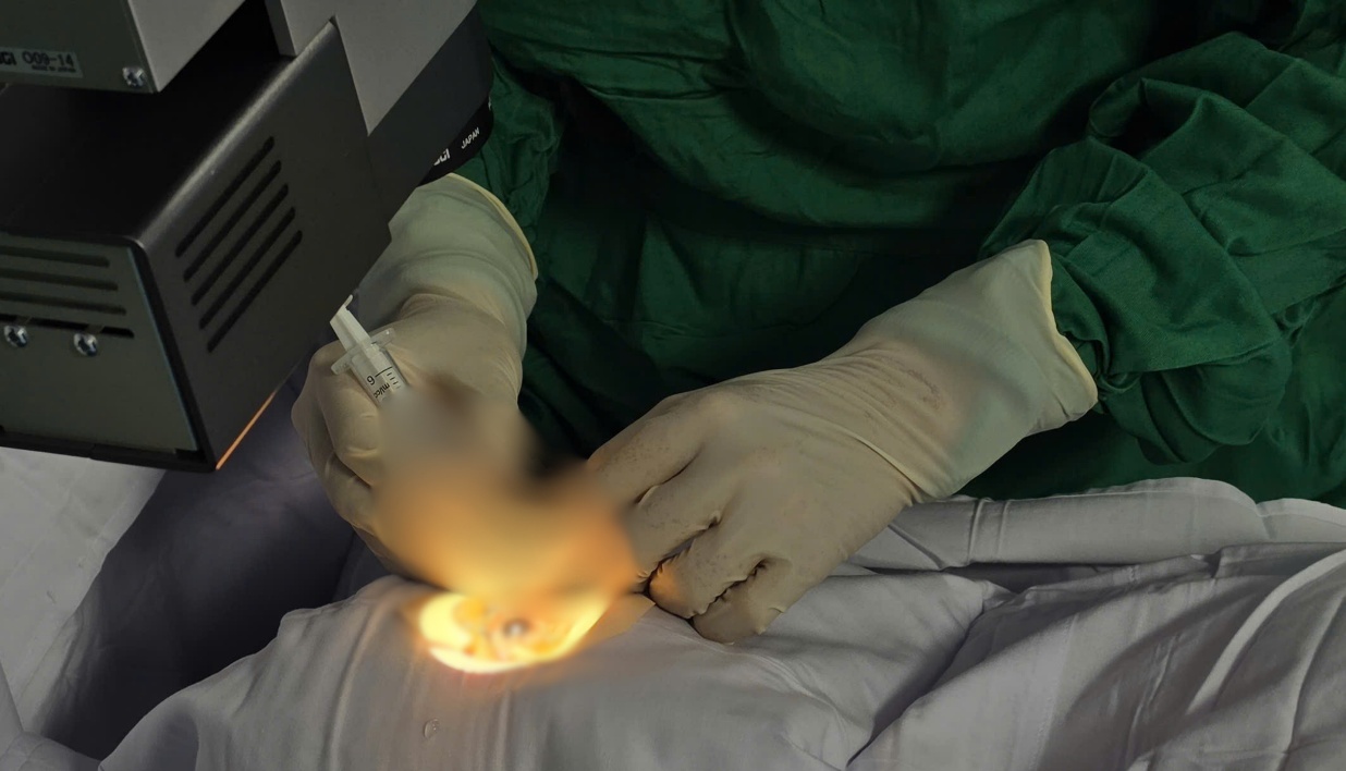 Hi hữu: Cấp cứu bệnh nh&acirc;n 37 tuổi bị ong ruồi ch&iacute;ch xuy&ecirc;n gi&aacute;c mạc  - Ảnh 2.