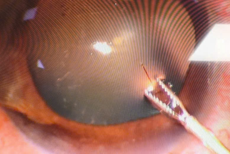 Hi hữu: Cấp cứu bệnh nh&acirc;n 37 tuổi bị ong ruồi ch&iacute;ch xuy&ecirc;n gi&aacute;c mạc  - Ảnh 1.