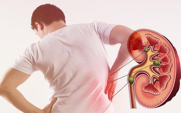 Thiếu nữ sinh 19 tuổi suy thận cấp, men gan tăng cao thừa nhận mắc sai lầm n&agrave;y trong l&uacute;c giảm c&acirc;n - Ảnh 3.