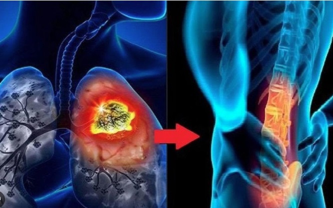 Người đ&agrave;n &ocirc;ng 60 tuổi ph&aacute;t hiện ung thư phổi giai đoạn 4 di căn n&atilde;o từ dấu hiệu nhiều người Việt mắc phải