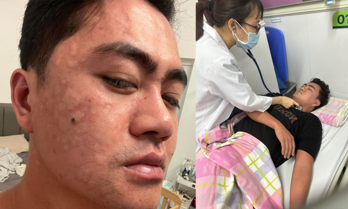 Thưởng thức b&aacute;nh trứng kiến đang hot: Người khen ngon, người nhập viện v&igrave; sốc phản vệ - Ảnh 1.