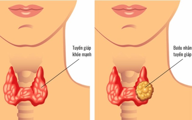 Chủ quan với nhăn tuyến giáp, người phụ nữ trẻ đi khám phát hiện 13 hạch di căn