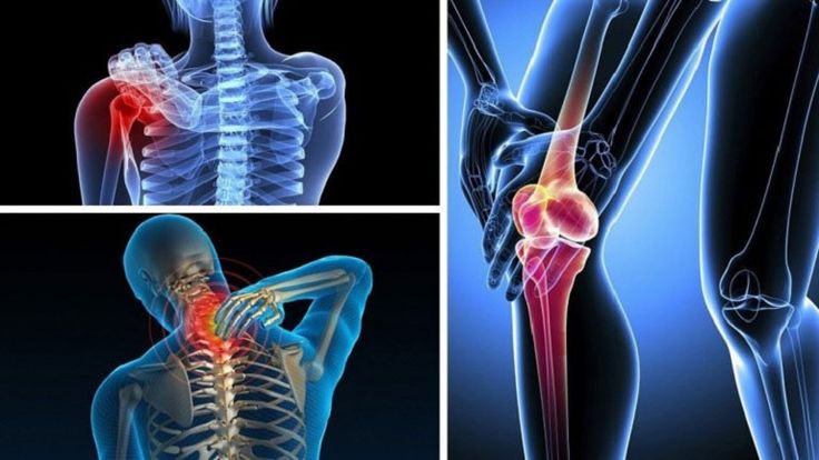 Đau xương kéo dài uống canxi không đỡ? Bác sĩ cảnh báo 6 dấu hiệu ung thư xương giai đoạn đầu dễ bị bỏ qua - Ảnh 1.