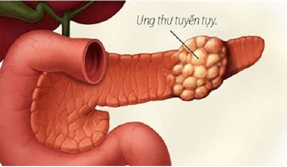 Người đ&agrave;n &ocirc;ng 30 tuổi bất ngờ ph&aacute;t hiện ung thư tụy từ dấu hiệu nhiều người Việt mắc phải - Ảnh 2.