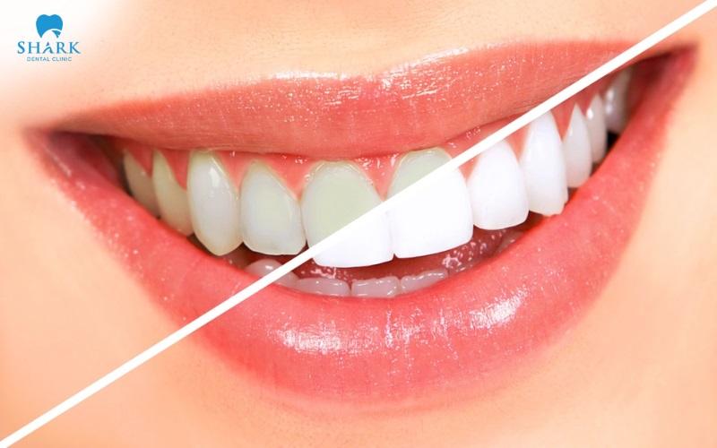 Tẩy trắng răng ở đ&acirc;u tốt? Kh&aacute;m ph&aacute; ngay địa chỉ tẩy trắng răng được nhiều kh&aacute;ch h&agrave;ng tin chọn - Ảnh 1.