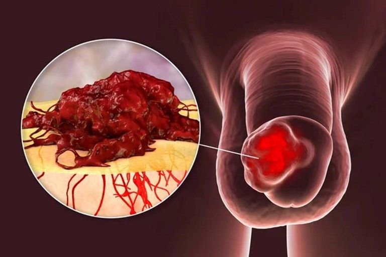 C&aacute;c dấu hiệu sớm của ung thư dương vật- Ảnh 1.