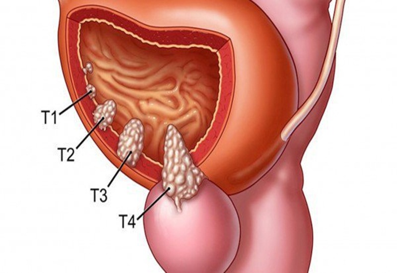 Người đàn ông 57 tuổi phát hiện u bàng quang từ dấu hiệu nhiều người Việt mắc phải nhưng bỏ qua - Ảnh 2.