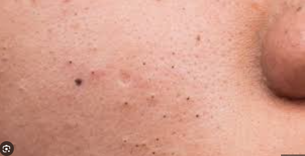 5 c&aacute;ch l&agrave;m mặt nạ trị mụn đầu đen tại nh&agrave; từ nguy&ecirc;n liệu tự nhi&ecirc;n - Ảnh 1.