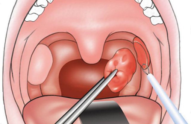 Bé gái 6 tuổi tăng huyết áp, viêm cầu thận cấp vì biến chứng viêm amidan - Ảnh 2. Bé gái 6 tuổi tăng huyết áp, viêm cầu thận cấp vì biến chứng viêm amidan - Ảnh 2.