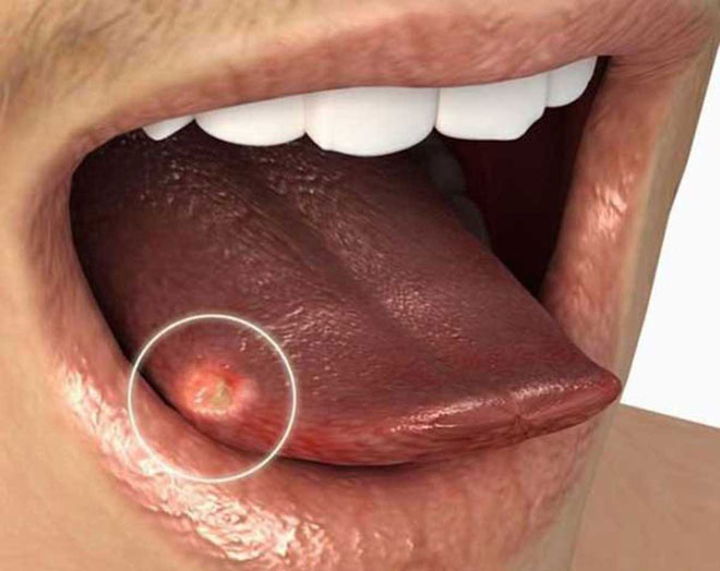 Người đàn ông 33 tuổi phát hiện ung thư lưỡi sau 4 - Ảnh 2. Người đàn ông 33 tuổi phát hiện ung thư lưỡi sau 4 - Ảnh 2.
