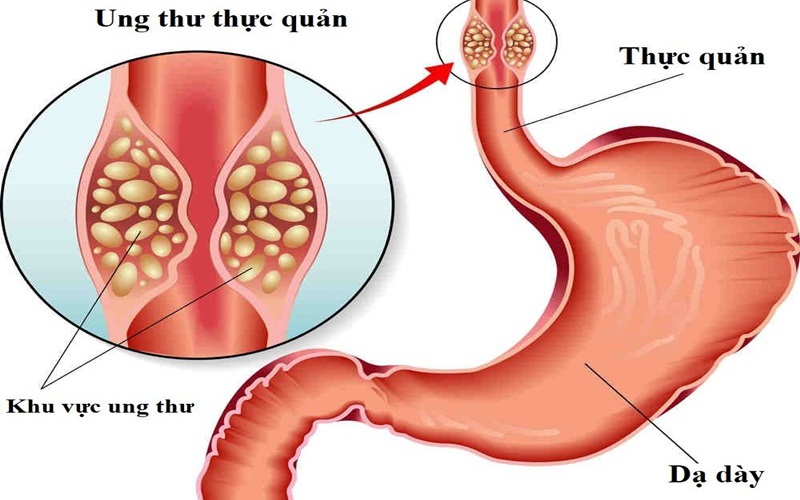 Người đ&agrave;n &ocirc;ng ph&aacute;t hiện mắc ung thư thực quản thừa nhận 2 sai lầm nhiều người Việt mắc phải - Ảnh 3.